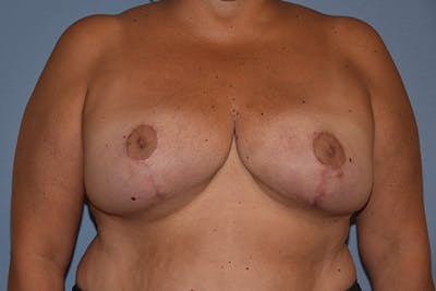 Breast Reduction Before & After Gallery - Patient 274129 - Image 2