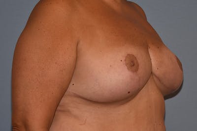 Breast Reduction Before & After Gallery - Patient 274129 - Image 4