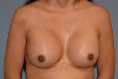 Breast Augmentation Before & After Gallery - Patient 106935 - Image 2