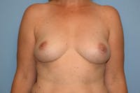 Breast Reconstruction Before & After Gallery - Patient 197536 - Image 1