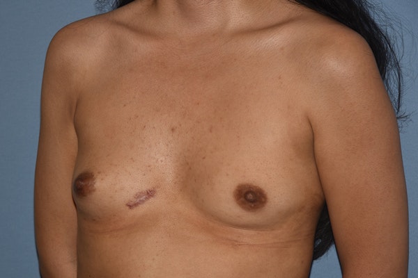 Breast Augmentation Before & After Gallery - Patient 106935 - Image 3