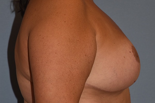 Breast Reduction Before & After Gallery - Patient 274129 - Image 6