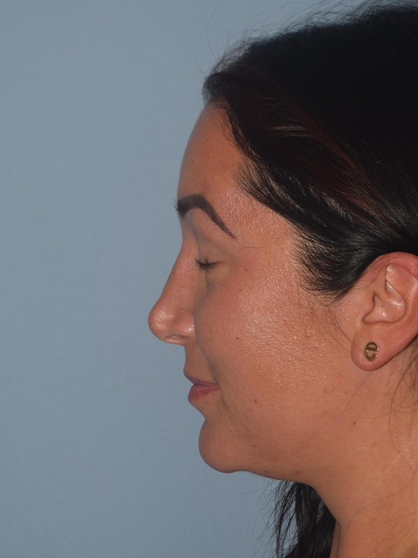 Rhinoplasty Before & After Gallery - Patient 266574 - Image 7