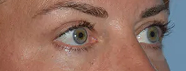 Eyelid Lift Before & After Gallery - Patient 947957 - Image 8