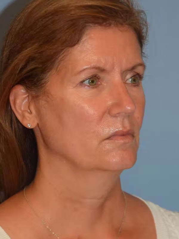 Facelift Before & After Gallery - Patient 328217 - Image 3
