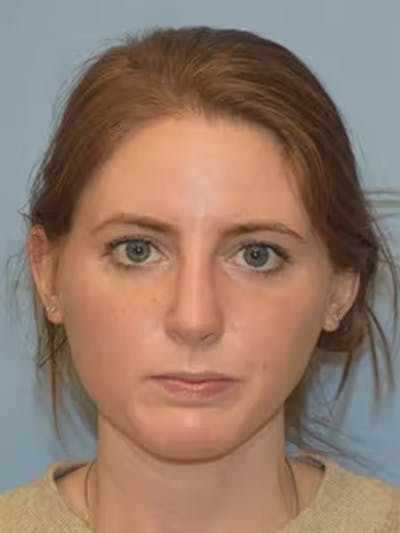 Rhinoplasty Before & After Gallery - Patient 296824 - Image 6
