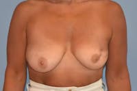 Breast Reconstruction Before & After Gallery - Patient 472077 - Image 1