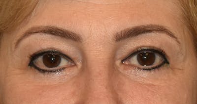 Eyelid Lift Before & After Gallery - Patient 385487 - Image 2