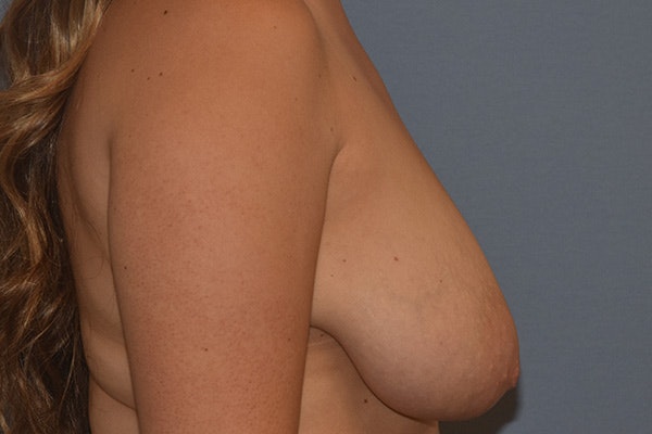 Breast Reduction Before & After Gallery - Patient 104451 - Image 5