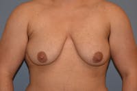 Gynecomastia Before & After Gallery - Patient 178302 - Image 1