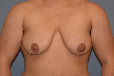 Gynecomastia Before & After Gallery - Patient 178302 - Image 1