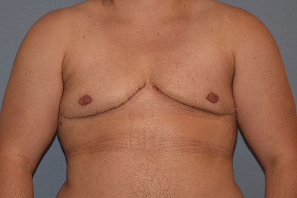 Gynecomastia Before & After Gallery - Patient 178302 - Image 2