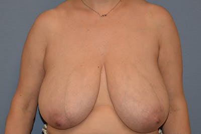 Breast Reduction Before & After Gallery - Patient 256032 - Image 1