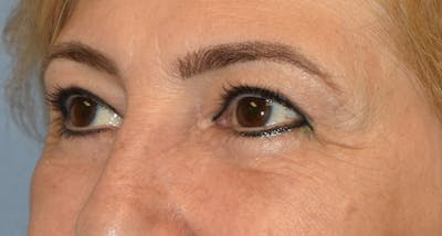 Eyelid Lift Before & After Gallery - Patient 385487 - Image 4