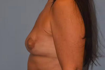 Breast Reconstruction Before & After Gallery - Patient 472077 - Image 6