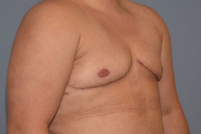 Gynecomastia Before & After Gallery - Patient 178302 - Image 4