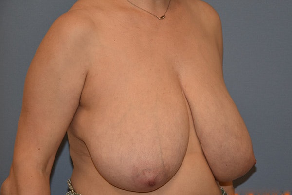 Breast Reduction Before & After Gallery - Patient 256032 - Image 3