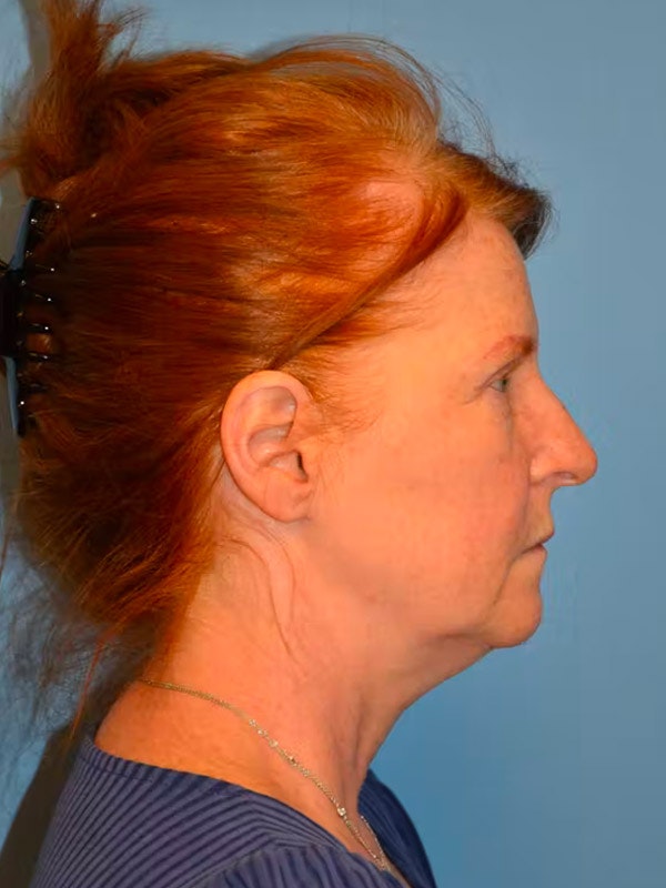 Facelift Before & After Gallery - Patient 233725 - Image 7