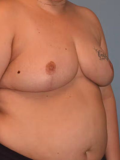 Breast Reduction Before & After Gallery - Patient 184916 - Image 4