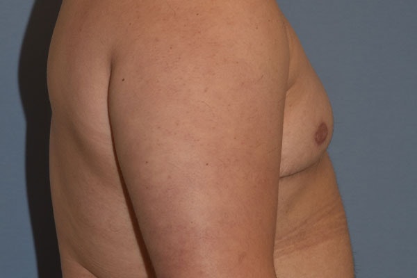 Gynecomastia Before & After Gallery - Patient 178302 - Image 6