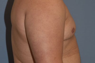 Gynecomastia Before & After Gallery - Patient 178302 - Image 6