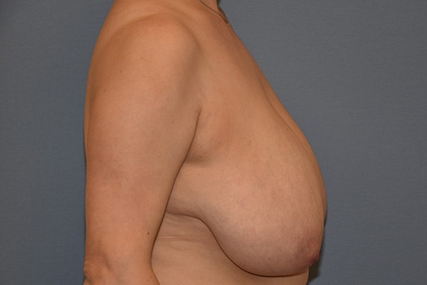 Breast Reduction Before & After Gallery - Patient 256032 - Image 5