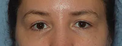 Eyelid Lift Before & After Gallery - Patient 234216 - Image 1