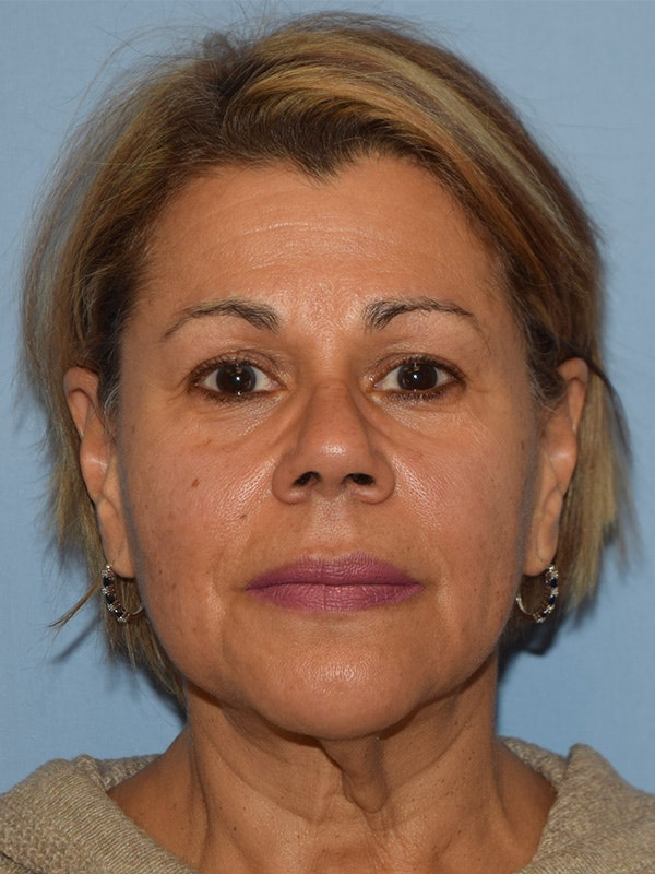 Facelift