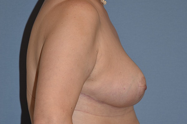 Breast Reduction Before & After Gallery - Patient 256032 - Image 6