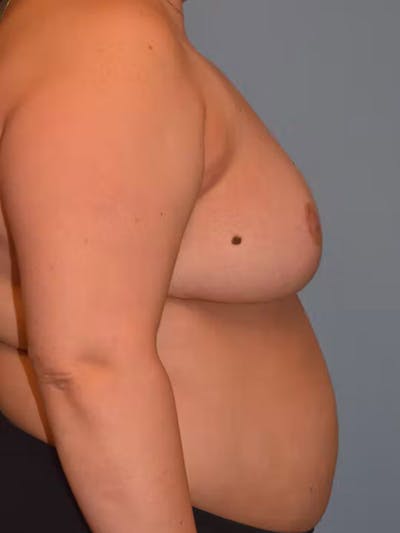 Breast Reduction Before & After Gallery - Patient 184916 - Image 6