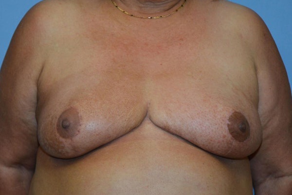 Breast Reconstruction Before & After Gallery - Patient 116690 - Image 6