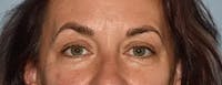 Eyelid Lift Before & After Gallery - Patient 337386 - Image 1