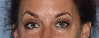 Eyelid Lift Before & After Gallery - Patient 337386 - Image 2