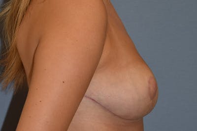 Breast Reduction Before & After Gallery - Patient 403373 - Image 6