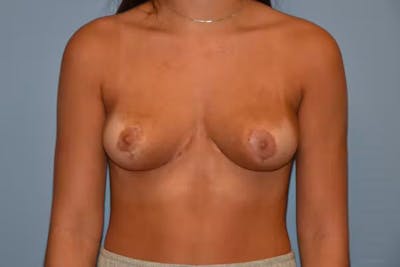 Breast Reduction Before & After Gallery - Patient 389335 - Image 2