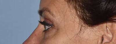 Eyelid Lift Before & After Gallery - Patient 337386 - Image 6