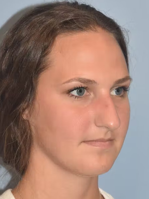 Rhinoplasty Before & After Gallery - Patient 365794 - Image 5