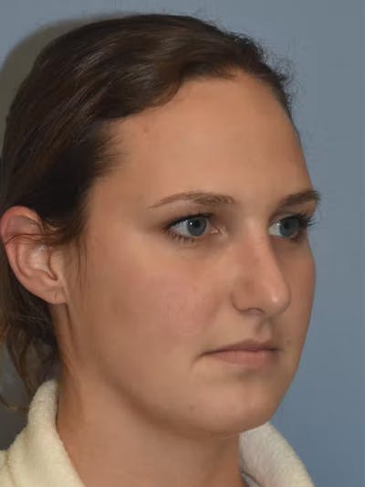 Rhinoplasty Before & After Gallery - Patient 365794 - Image 6