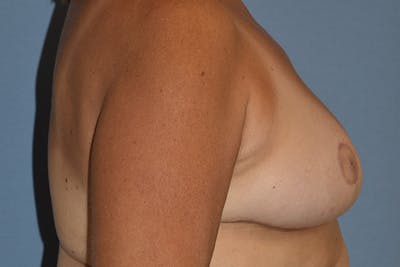 Breast Reduction Before & After Gallery - Patient 154608 - Image 6