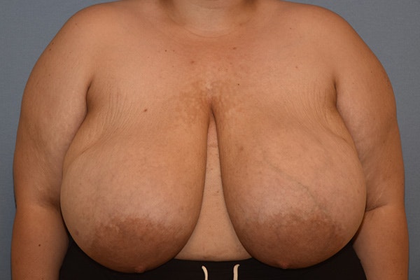 Breast Reduction Before & After Gallery - Patient 312802 - Image 1