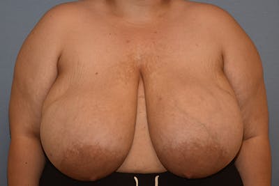 Breast Reduction Before & After Gallery - Patient 312802 - Image 1
