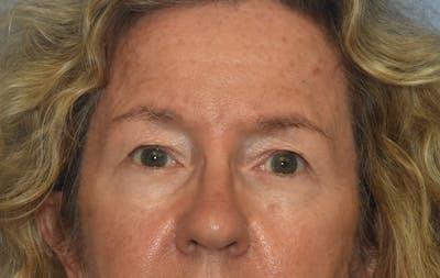 Eyelid Lift Before & After Gallery - Patient 531912 - Image 1