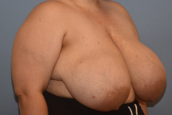 Breast Reduction Before & After Gallery - Patient 312802 - Image 3