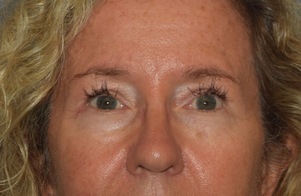 Eyelid Lift Before & After Gallery - Patient 531912 - Image 2