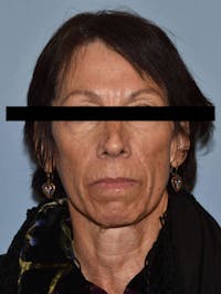 Facelift Before & After Gallery - Patient 420603 - Image 1