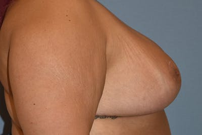 Breast Reduction Before & After Gallery - Patient 312802 - Image 6