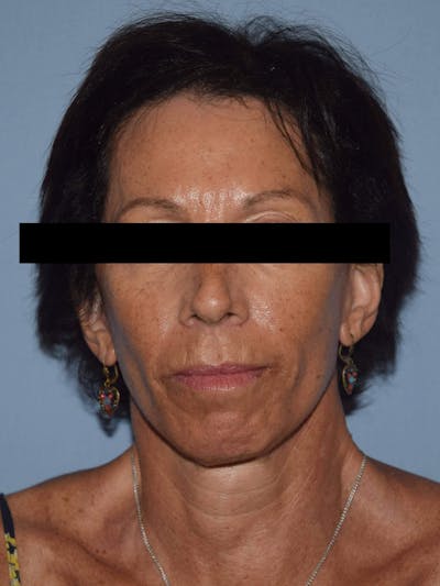 Facelift Before & After Gallery - Patient 420603 - Image 2