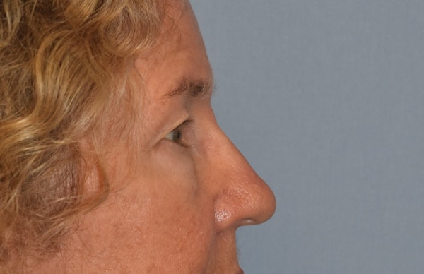 Eyelid Lift Before & After Gallery - Patient 531912 - Image 5