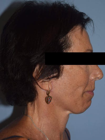 Facelift Before & After Gallery - Patient 420603 - Image 4