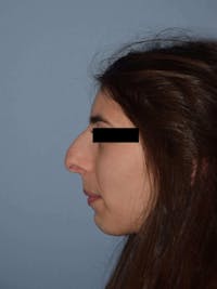 Rhinoplasty Before & After Gallery - Patient 346863 - Image 1